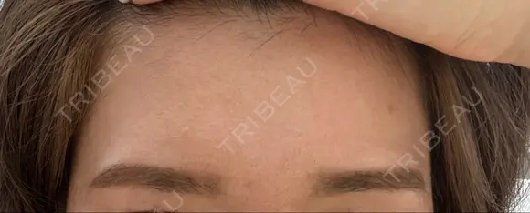 ヒアルロン酸注入（額） / ヒアルロン酸注入（こめかみ） BRIGHTS beauty clinic BEFORE メイン用