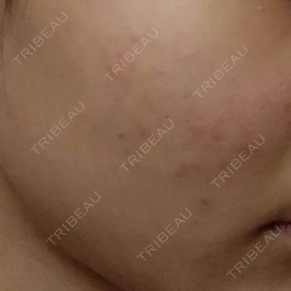 ピーリング（ニキビ・毛穴） 表参道スキンクリニック 大阪院 BEFORE メイン用