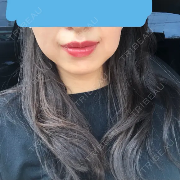 ボトックス（エラ・小顔） / 脂肪溶解注射（顔） あいちビューティークリニック BEFORE メイン用