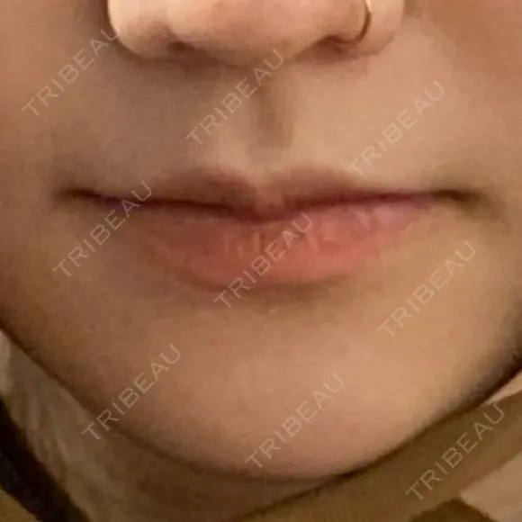 ヒアルロン酸注入（唇） / ボトックス（口角） グランメドクリニック茨木 BEFORE メイン用