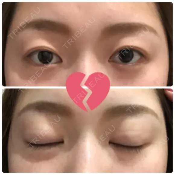 二重埋没 湘南美容クリニック 新宿南口院 BEFORE メイン用