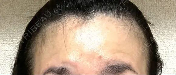 ボトックス（額） BRIGHTS beauty clinic BEFORE メイン用