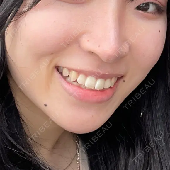 ホワイトニング 池袋麗歯科・美容皮膚科 BEFORE メイン用