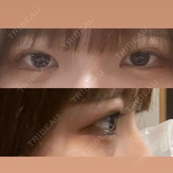 二重切開 / 目頭切開 / クマ治療 / 上まぶたの脂肪取り / 下まぶたの脂肪取り / タレ目形成・グラマラスライン（切開） BRIGHTS beauty clinic BEFORE メイン用