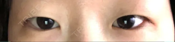 二重埋没 湘南美容クリニック 松山院 BEFORE メイン用