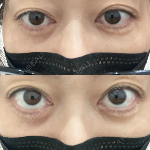 二重埋没 EMMO FACE CLINIC 大宮院 BEFORE メイン用