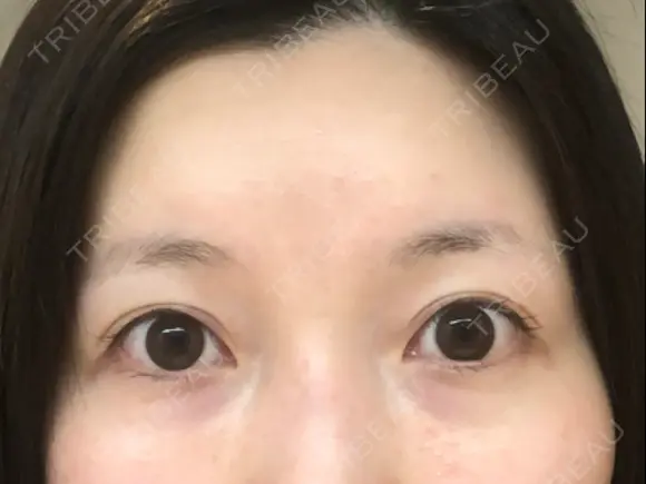 その他（目元） / クマ治療 / 上まぶたたるみ取り / 下まぶたたるみ取り eクリニック 金沢本院 BEFORE メイン用