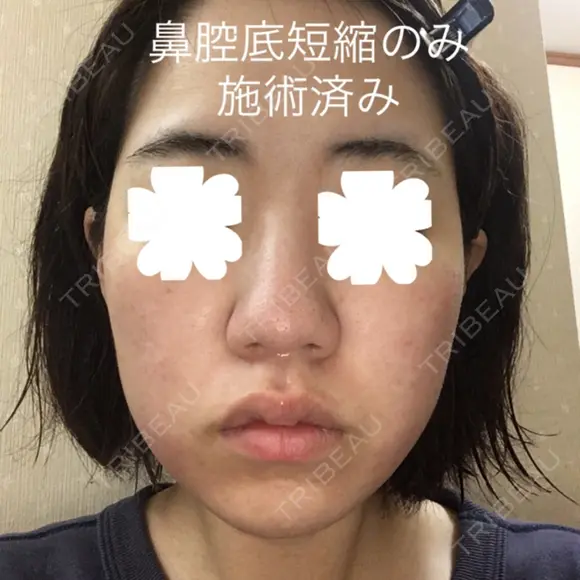 鼻尖形成（切開） / 小鼻縮小（切開） / その他（鼻） / 軟骨移植 JUN CLINIC BEFORE メイン用