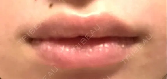 口角挙上 くさのたろうクリニック BEFORE メイン用