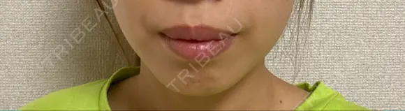 あごプロテーゼ エースクリニック 名古屋院 BEFORE メイン用