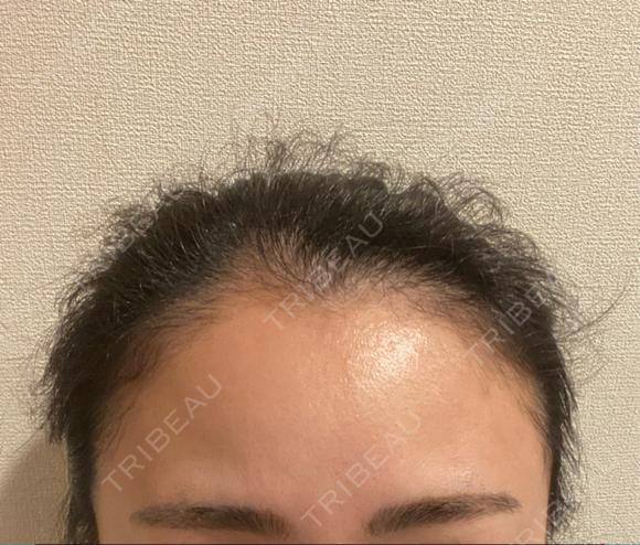 アートメイク（ヘアライン） トイトイトイクリニック 池袋院 BEFORE メイン用