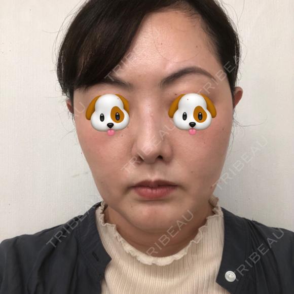 ハイフ（顔） オーキッド美容クリニック東京御徒町 BEFORE メイン用