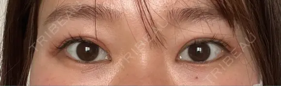 二重切開 / 目元修正 こまちクリニック BEFORE メイン用