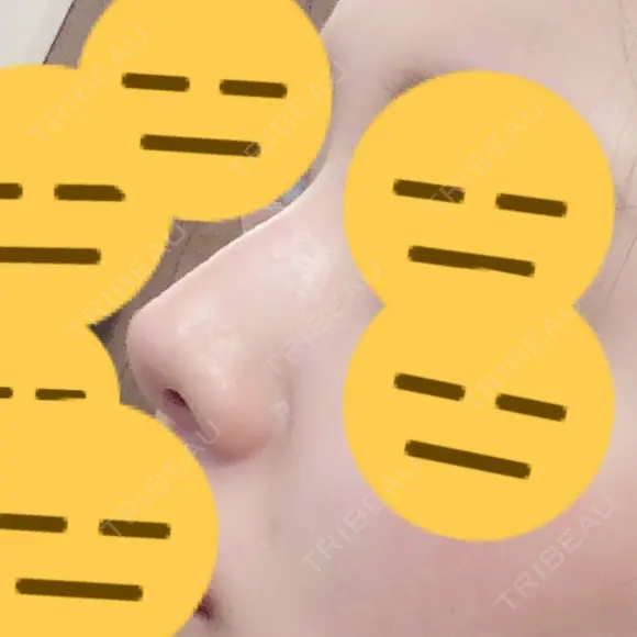 隆鼻術 / 軟骨移植 / 骨切幅寄せ / 鼻修正 / 鼻孔縁挙上 / 真皮移植 KOKO整形外科 BEFORE メイン用