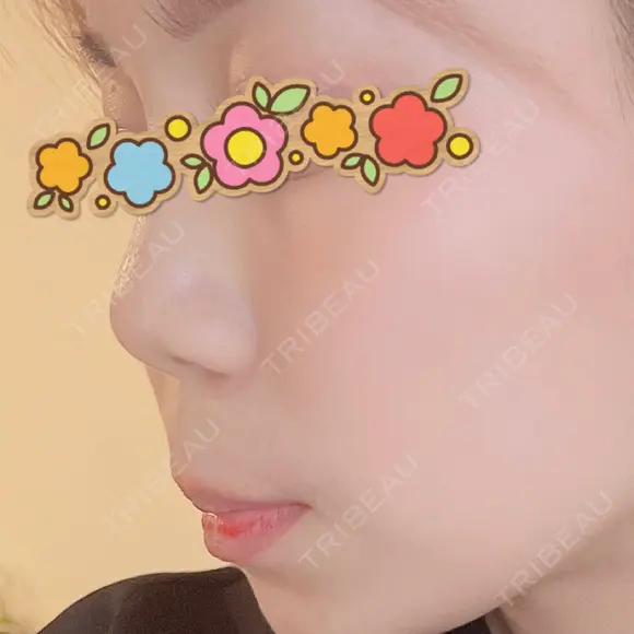鼻尖形成（切開） / 鼻中隔延長（切開） / 軟骨移植 / 鼻翼基部形成（貴族手術） / 鼻柱下降・鼻唇角形成（猫手術） MAe Clinic 東京院 BEFORE メイン用