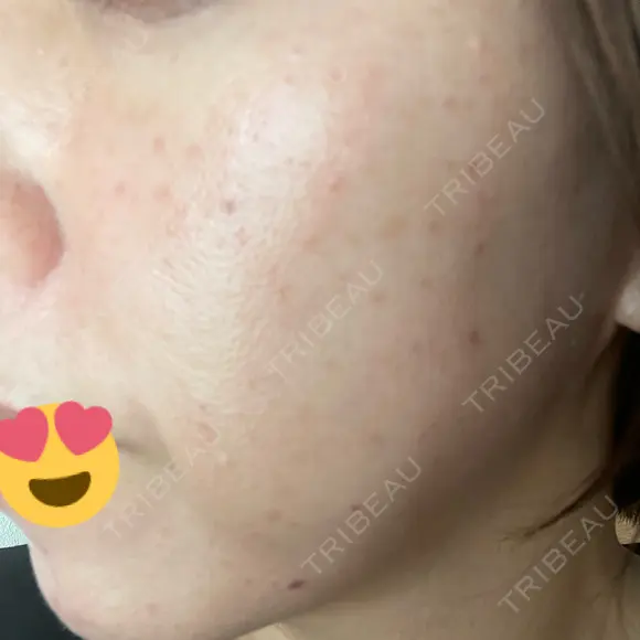 美肌レーザー / シミ取りレーザー あいちビューティークリニック BEFORE メイン用