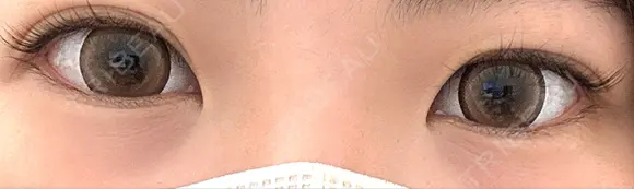 ヒアルロン酸注入（涙袋） TCB東京中央美容外科 長野院 BEFORE メイン用