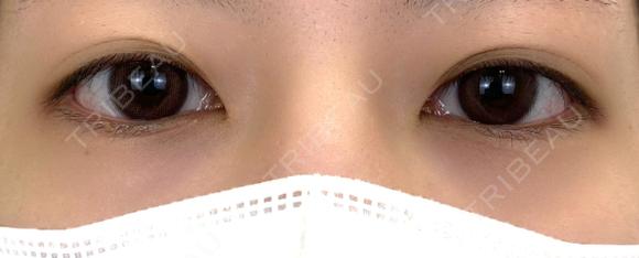 二重埋没 NARU Beauty Clinic 【ナルクリ】 BEFORE メイン用