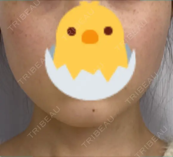 ボトックス（エラ・小顔） TCB東京中央美容外科 長野院 BEFORE メイン用