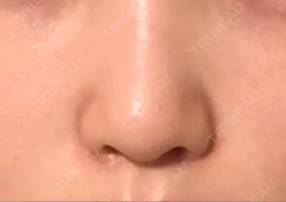 鼻尖形成（切開） / 軟骨移植 JUN CLINIC BEFORE メイン用