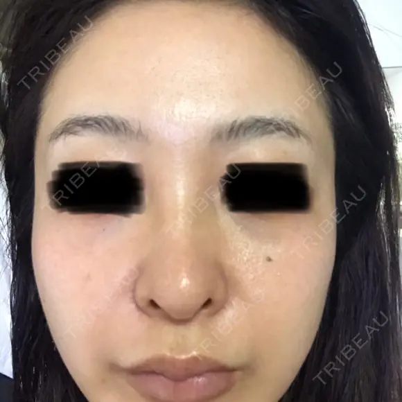 ピコレーザートーニング（美白・肝斑） ルラ美容クリニック 高田馬場院 BEFORE メイン用