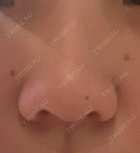 鼻中隔延長（切開） / 鼻尖縮小 ビスポーククリニック 福岡院 BEFORE メイン用