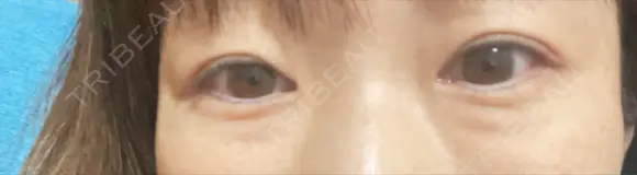 クマ治療 / 脂肪注入（肌） / ボトックス（あご） 銀座みゆき通り美容外科 大阪梅田院 BEFORE メイン用