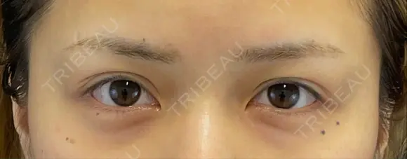 二重埋没 BELINDA CLINIC（ベリンダクリニック）新宿院 BEFORE メイン用
