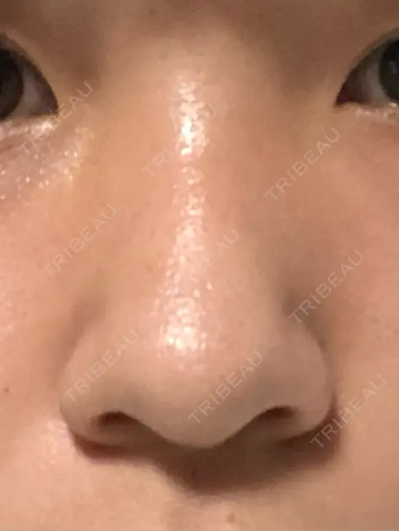 小鼻縮小（切開） / 鼻尖形成（非切開） ASTRA BEAUTY CLINIC BEFORE メイン用