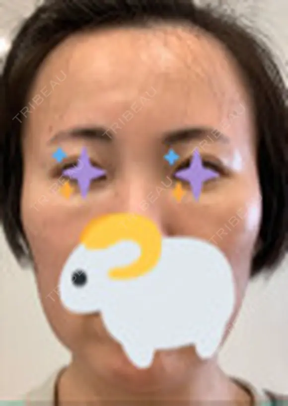 ヒアルロン酸注入（額） / ヒアルロン酸注入（こめかみ） ユウコ形成外科クリニック BEFORE メイン用