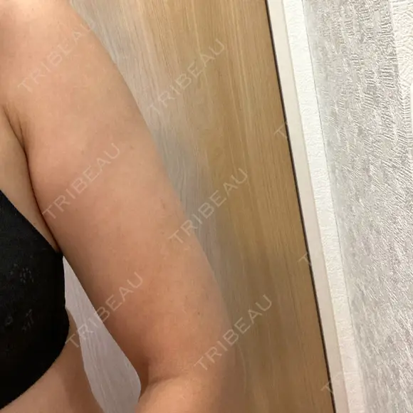 脂肪溶解注射（二の腕） 石倉クリニック 水戸院 BEFORE メイン用