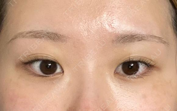 二重埋没 フローラクリニック BEFORE メイン用