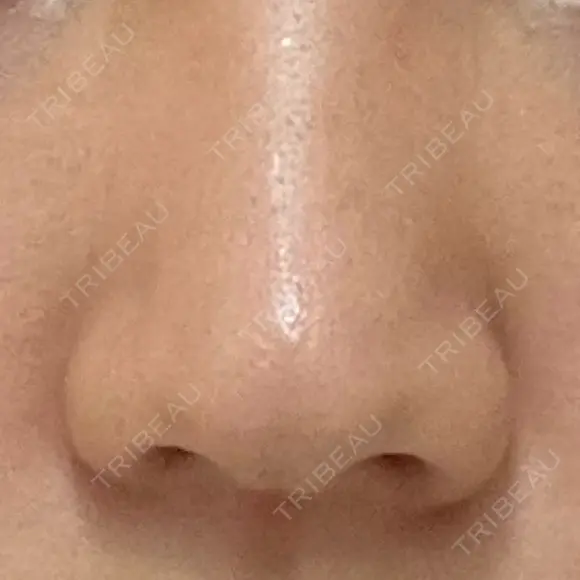 小鼻縮小（切開） GLANZ CLINIC BEFORE メイン用