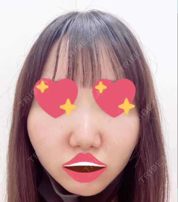 隆鼻術 / 軟骨移植 フェアクリニック川口 BEFORE メイン用