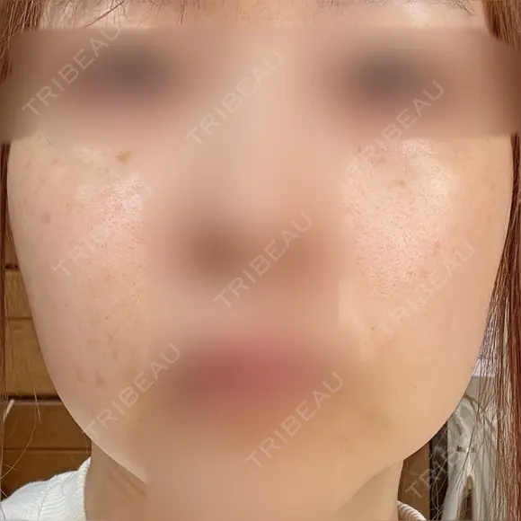 ヴェルヴェットスキン アリエル美容クリニック 大宮院 BEFORE メイン用