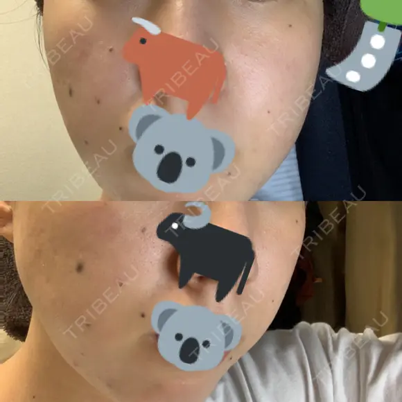 ほくろ・いぼ除去レーザー（肌） 心斎橋形成外科スキンケアクリニック BEFORE メイン用