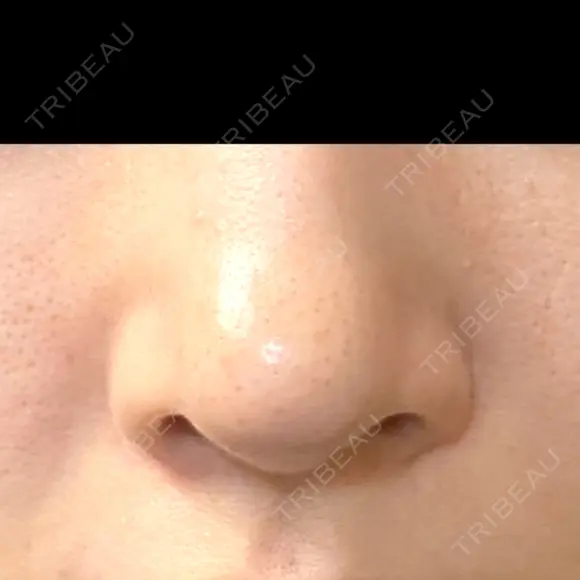小鼻縮小（切開） 山本クリニック BEFORE メイン用