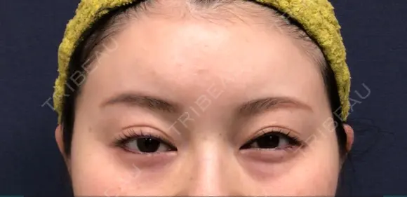 クマ治療 / ヒアルロン酸注入（額） あじまビューティークリニック BEFORE メイン用