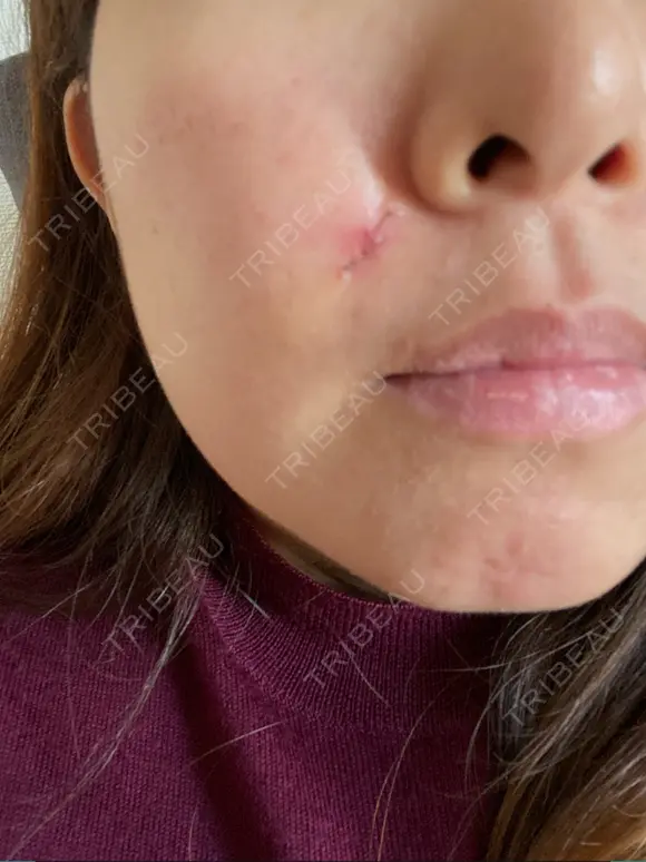 ほくろ・いぼ切除（肌） LIKI CLINIC KOBE BEFORE メイン用