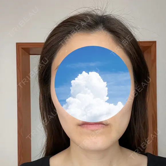 糸リフト / 骨切り（あご） / 骨削り（エラ） / 脂肪吸引（顔） 銀座マイアミ美容外科 BEFORE メイン用