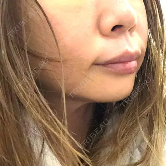 ヒアルロン酸注入（あご） TCB東京中央美容外科 世田谷院 BEFORE メイン用