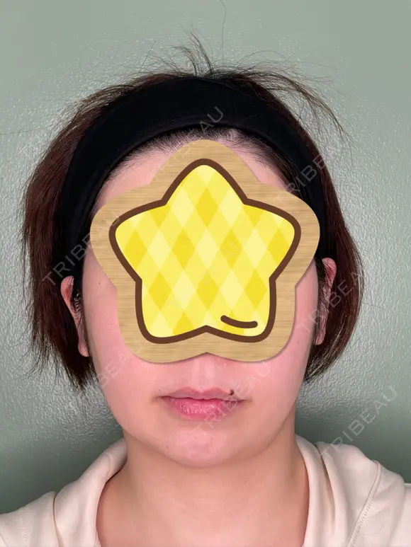あごプロテーゼ くさのたろうクリニック BEFORE メイン用