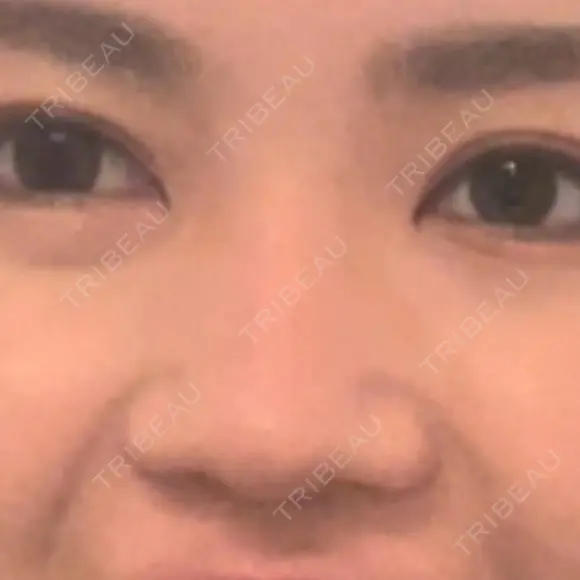 鼻尖形成（切開） / 鼻中隔延長（切開） / 鼻尖縮小 / 鼻柱下降・鼻唇角形成（猫手術） KAUNIS CLINIC（カウニスクリニック） BEFORE メイン用