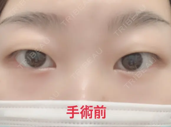 二重埋没 / 上まぶたの脂肪取り 湘南美容クリニック 奈良院 BEFORE メイン用