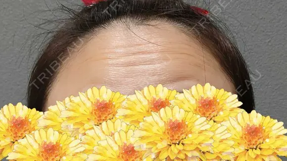 ボトックス（目尻） / スネコス YBC横浜美容外科 大宮院 BEFORE メイン用