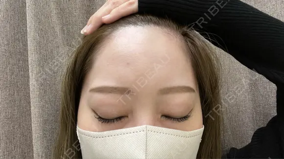 ヒアルロン酸注入（額） / ヒアルロン酸注入（こめかみ） 渋谷美容外科クリニック 新宿院 BEFORE メイン用