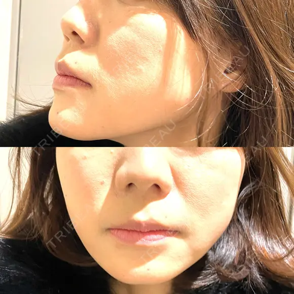 ボトックス（エラ・小顔） TCB東京中央美容外科 京都駅前院 BEFORE メイン用