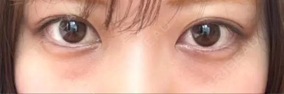 クマ治療 / 下まぶたたるみ取り / 下まぶたの脂肪取り APOLLO BEAUTY CLINIC BEFORE メイン用