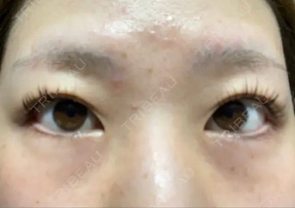 眼瞼下垂（切開） ステラ ロサ クリニック BEFORE メイン用