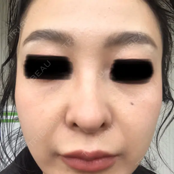 ピコレーザートーニング（美白・肝斑） ルラ美容クリニック 高田馬場院 BEFORE メイン用